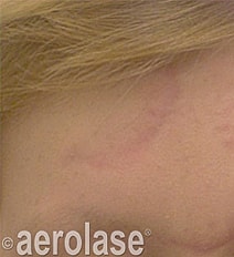 Aerolase Era Laser Before & After