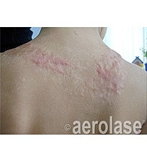 Aerolase Era Laser Before & After