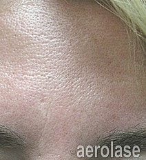 Aerolase Era Laser Before & After