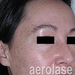 Aerolase Era Laser Before & After
