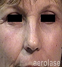 Aerolase Era Laser Before & After