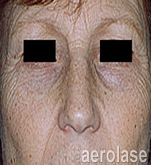 Aerolase Era Laser Before & After