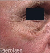 Aerolase Era Laser Before & After