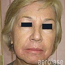 Aerolase Era Laser Before & After