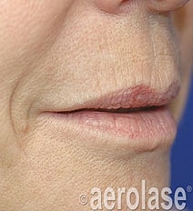 Aerolase Era Laser Before & After