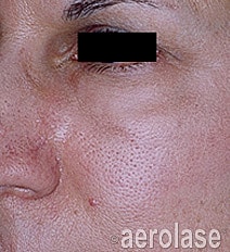 Aerolase Era Laser Before & After