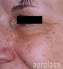 Aerolase Era Laser Before & After