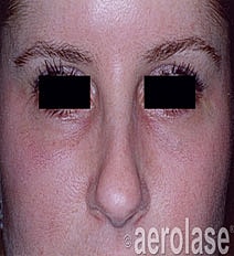 Aerolase Era Laser Before & After