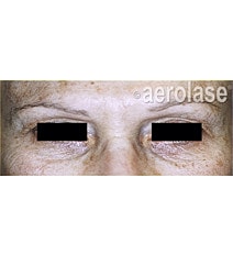 Aerolase Era Laser Before & After