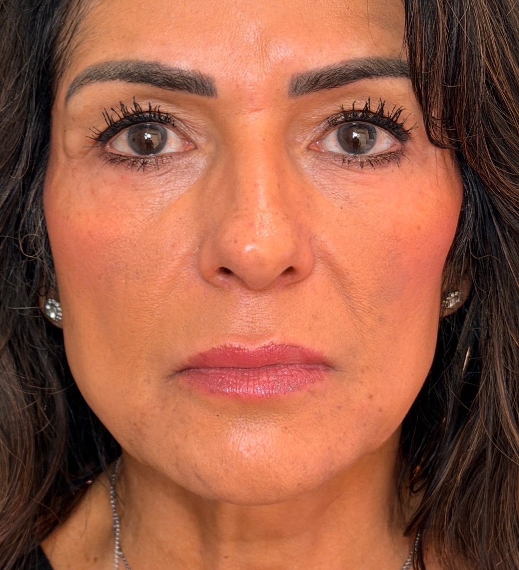 Front view of the same woman’s cheeks and mid-face after Radiesse treatment.