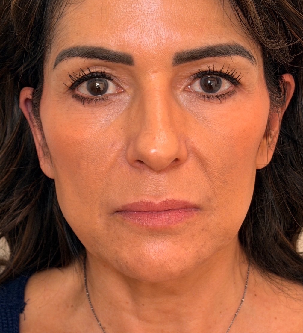 Front view of a woman’s cheeks and mid-face before Radiesse treatment.