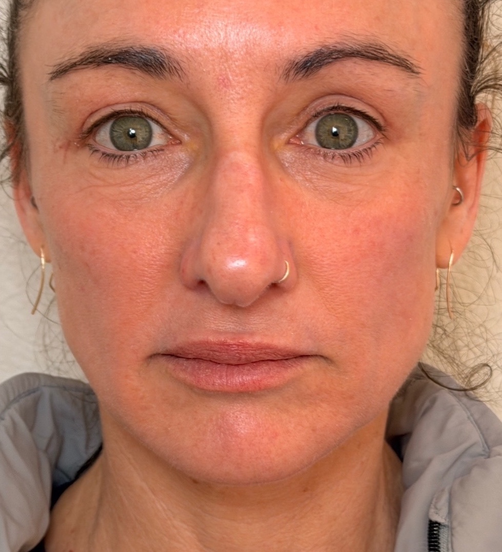 Front view of the same woman’s mid-face and jawline after Radiesse treatment.