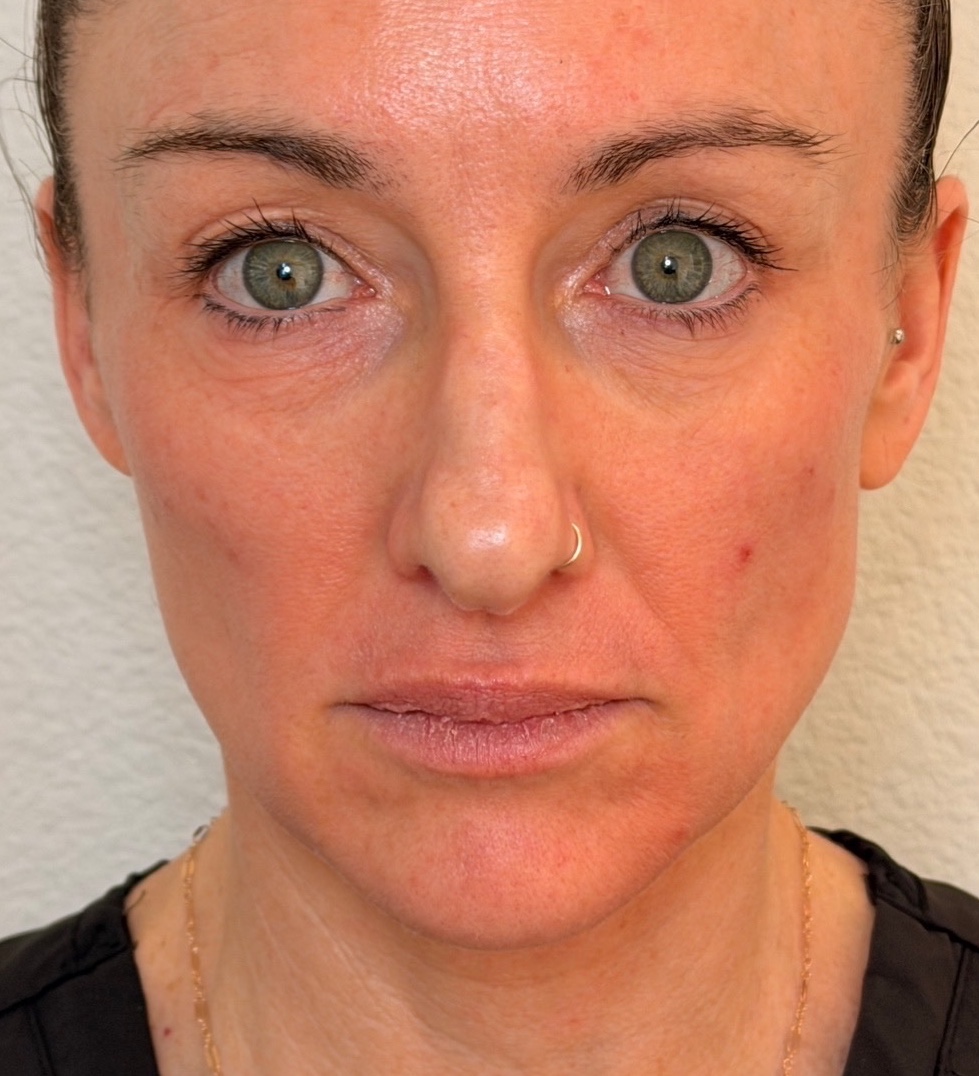 Front view of a woman’s mid-face and jawline before Radiesse treatment.