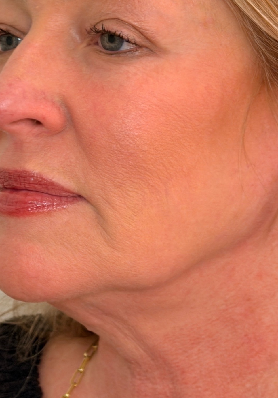 Three-quarter view of the same woman’s jawline and neck after Radiesse treatment.