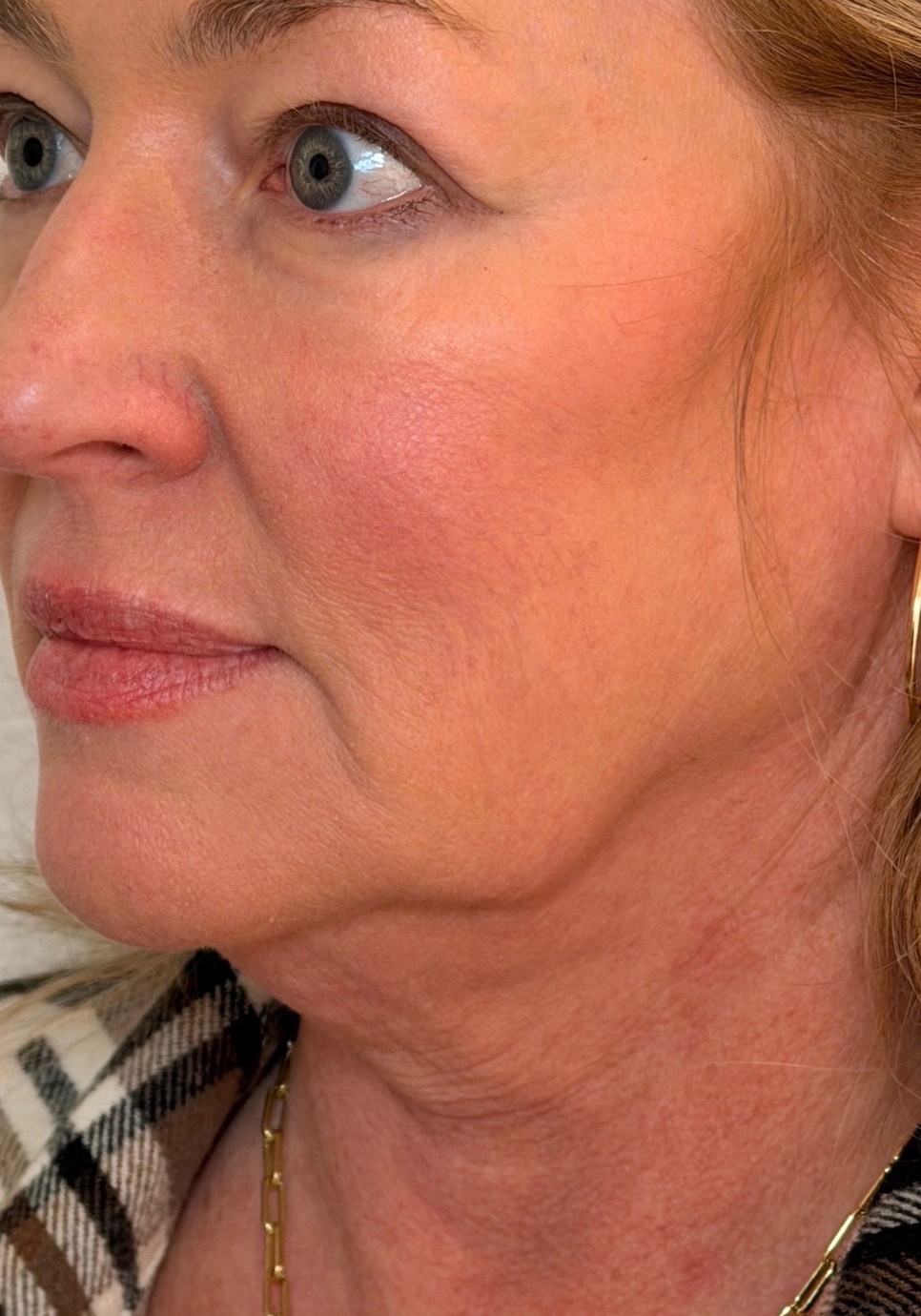 Three-quarter view of a woman’s jawline and neck before Radiesse treatment.