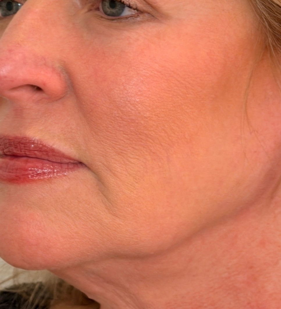 Three-quarter view of the same woman’s jawline and neck after Radiesse treatment.