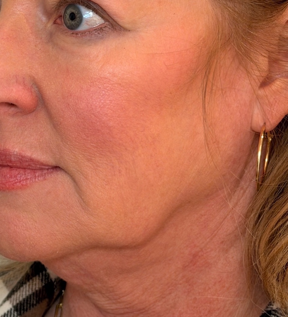 Three-quarter view of a woman’s jawline and neck before Radiesse treatment.