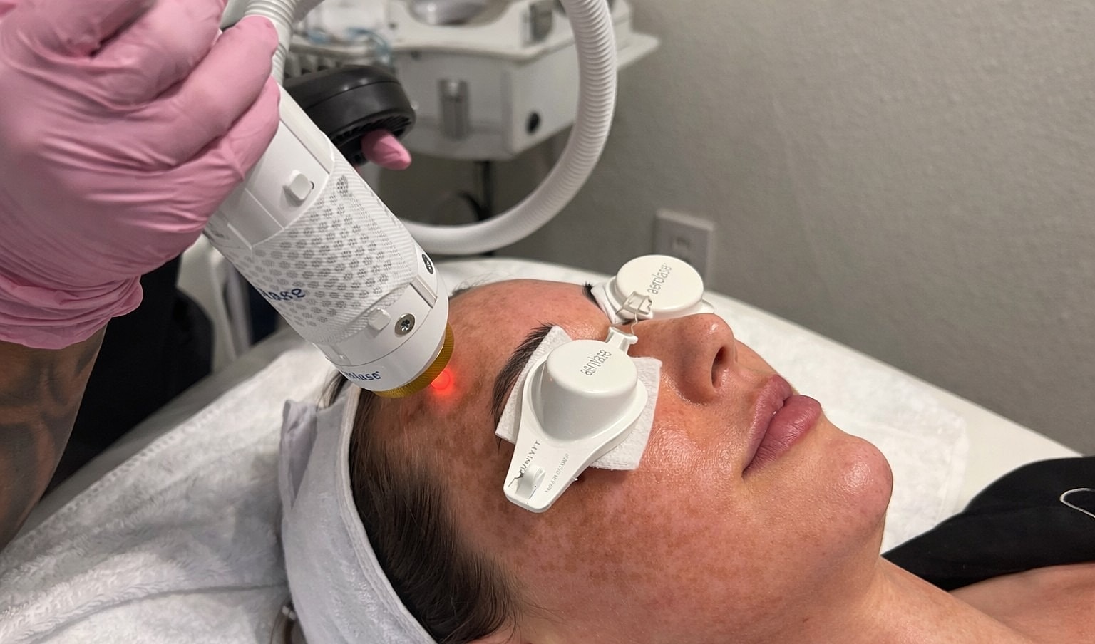 Laser treatment session on a woman's face.