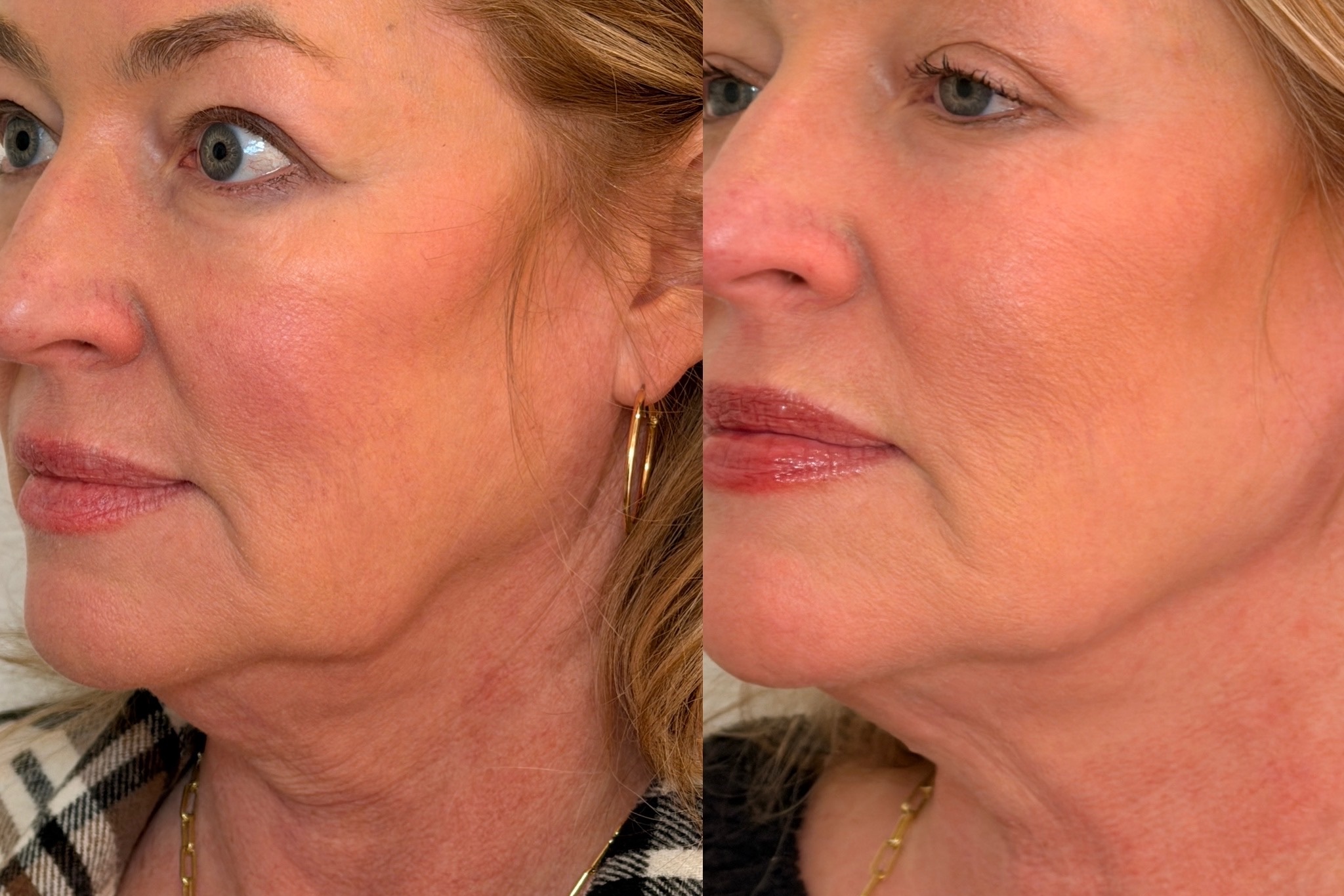 Side-by-side before and after of a woman’s jawline and neck.